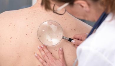 Endométriose et cancers cutanés