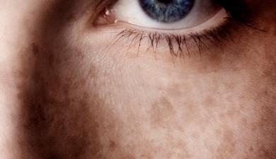 Facteurs génétiques communs à l’endométriose et au mélanome ?